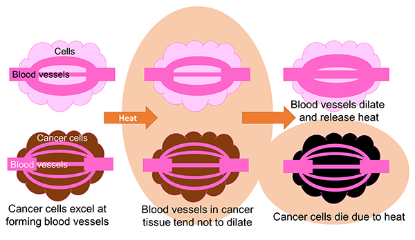 How thermotherapy works. The therapeutic mechanism exploits cancer tissue's tendency to accumulate heat.