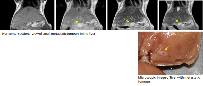 The nanomachine contrast agent produced a weaker signal in normal liver and a strong one in liver cancer, producing an extremely strong contrast. This enabled the detection of a small 1.5 mm colorectal cancer which had metastasized to the liver.