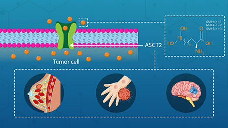Boron agents termed GluBs reach previously untreatable tumors