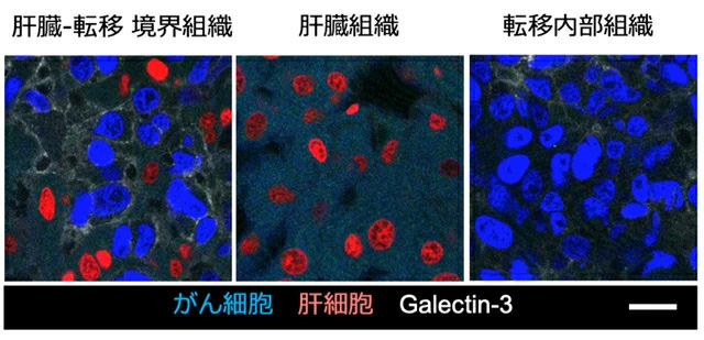 図4 galectin-3の免疫組織染色 肝転移が形成された肝臓組織において、肝組織と転移組織の境界領域、転移から遠位の肝組織に加えて、転移の内部組織におけるgalectin-3由来の蛍光シグナルを観察した。青色シグナルと赤色シグナルはそれぞれがん細胞と肝実質細胞の細胞核を、白色シグナルはgalectin-3タンパク質の存在を示す。図中のスケールバーは20 μmを示す。