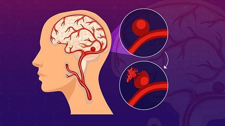 Smarter flow simulation model for analyzing blood flow in brain aneurysms