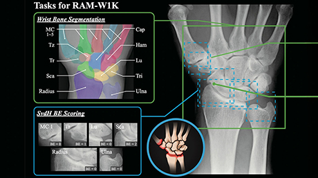 リウマチ画像解析の学習データとAIベンチマークを公開