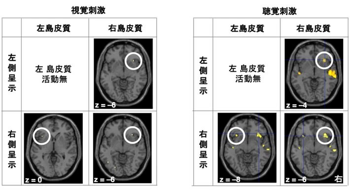 図4 右の島皮質は必ず活動している これは、fMRI実験で脳を水平面で撮影した図である（額が上を向いている）。左下のzは座標値で深さを示している。白い丸で囲ったところが前部島皮質で、活動が観察された部分が示されている。視覚刺激でも聴覚刺激でも右の島皮質は刺激呈示側に関係なく活動がある。